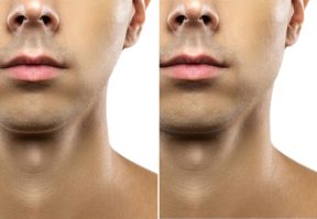 Thumbpulling: Can Your Thumbs Help Shape A Better Jawline?